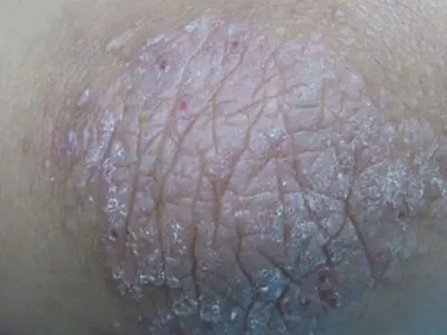 人的上身的放射性皮炎图片