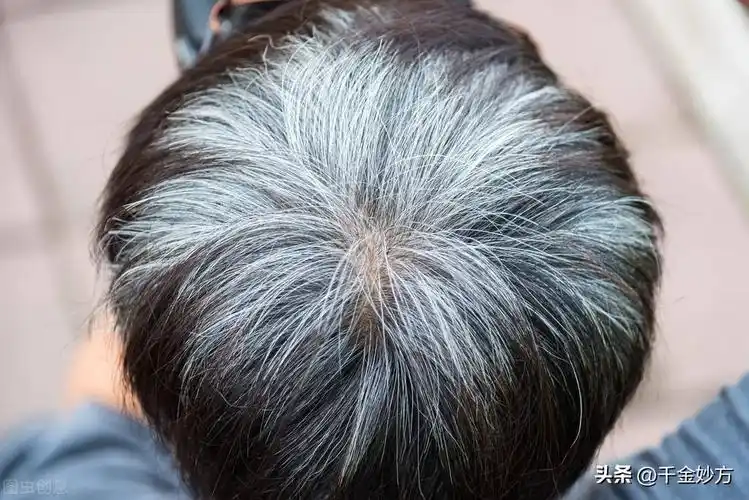 少年白发该如何治疗呢,遗传少年白发怎么治_友友