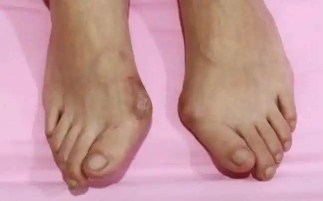 女士重度拇外翻,脚趾畸形挤压,拇囊隆突红肿疼痛,前来矫正,术后看到