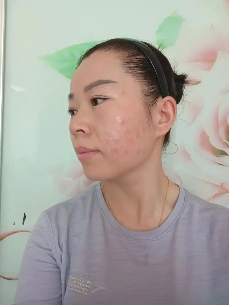 才回家几天,脸上突然过敏,双腿被蚊子都亲了一遍我太难了,我要 - 抖音