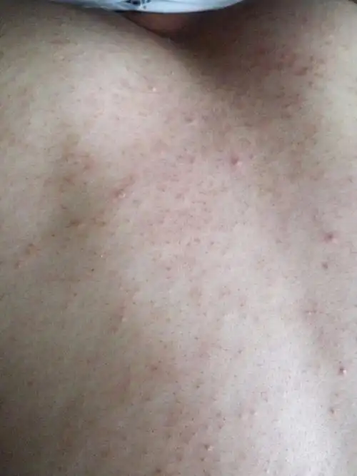 背部有如图的情况,是怎么回事,是不是皮肤病啊.急