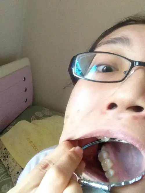 11岁的时候整过牙,下面没拔,上面拔了左右虎牙后面的两颗.