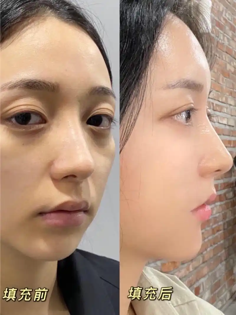 自体脂肪填充法令纹,面颊凹陷记录,没有凹陷真的显年轻啊!