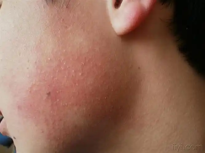 面颈部毛囊红斑黑变病. - 皮肤及性传播疾病讨论版 - 爱爱医医学论坛