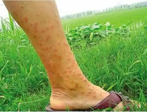 腿部夏季皮炎症状图片