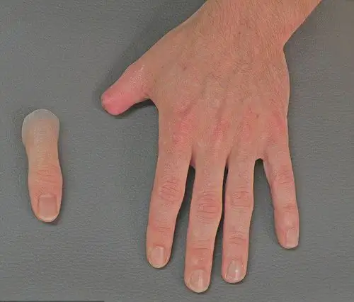 永州市 手指假肢如何安装?