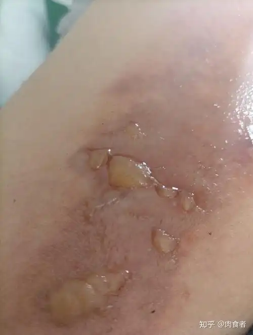 开水烫伤纪实 - 知乎