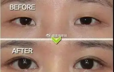 双眼皮|埋线和全切这两种双眼皮该如何选择?