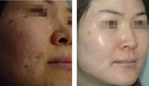 果酸换肤一次能看出效果吗