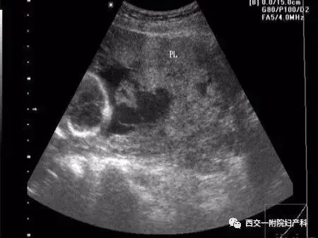 胎盘血池相关知识