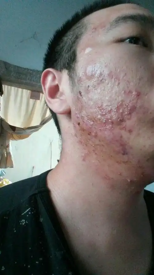 脸部毛囊炎怎么办,红红的,难看,几个月了都没有去找工作,不敢出去见人