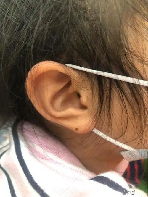 幼儿园小朋友耳朵上有痣,不用点掉吧 老干部闲聊 篱笆网 - 年轻家庭