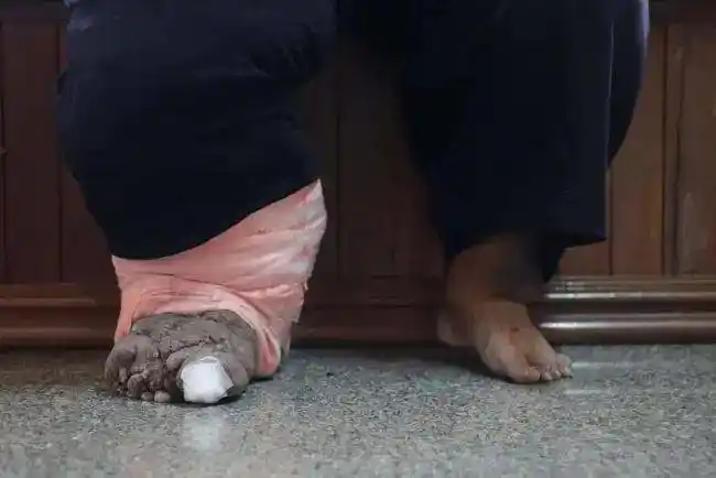 柬埔寨男子20年前染上寄生虫现左腿极度肿胀如小猪