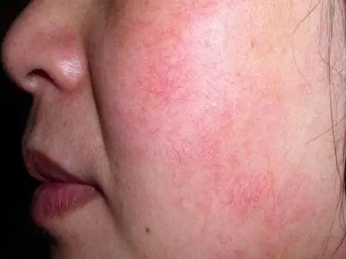 脸上出现红血丝该怎么办?