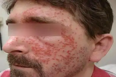 1,湿疹:湿疹是一种慢性炎症性瘙痒性皮肤病,患者在吃海鲜之后可能会