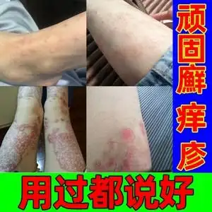 本草纲目药膏擦汗状疱疹手上小水泡手足干痒皮肤病牛皮癣皮肤外用