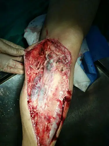 诊治左小腿软组织广泛碾压伤一例.