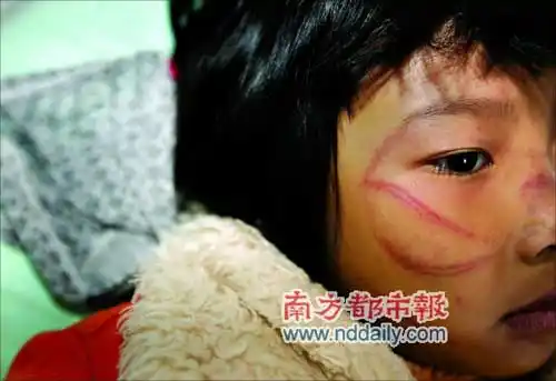 7岁女孩被母亲用衣架抽打满脸伤痕(图)