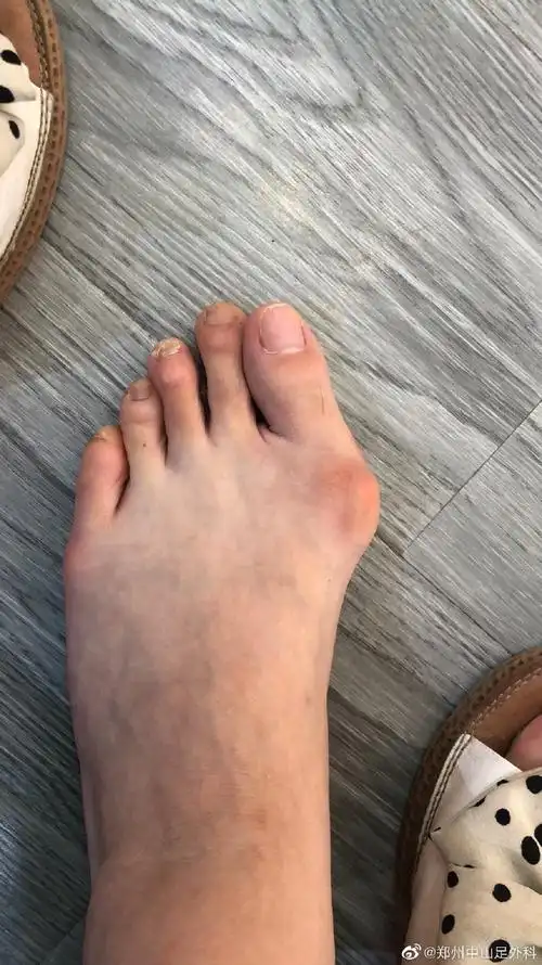 《郑州中山医院针刀微创治疗大脚骨案例》