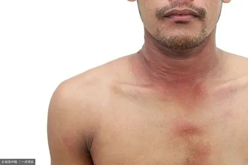 不论男女,身上出现「湿疹」,可能与这4个原因有关,早知道早好