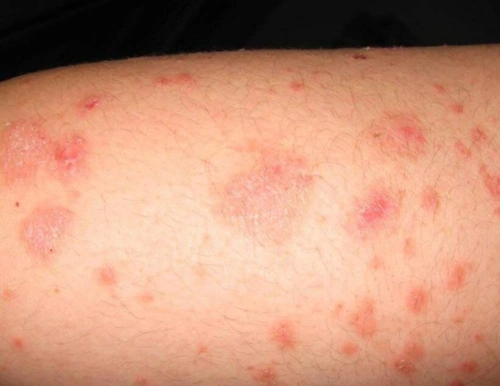 【体癣图片】_表现症状_怎么治疗_苹果绿