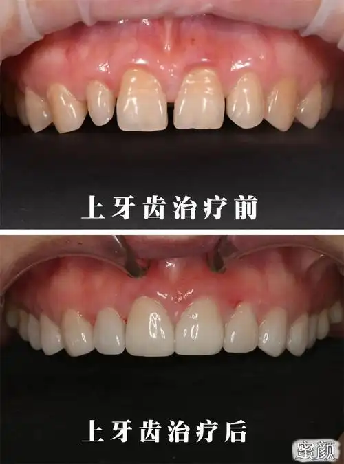 被牙齿贴面"拯救"了一口丑牙!-蜜颜整形优惠