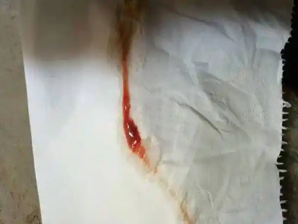 警惕内裤上出现这东西可能是宫颈癌预兆