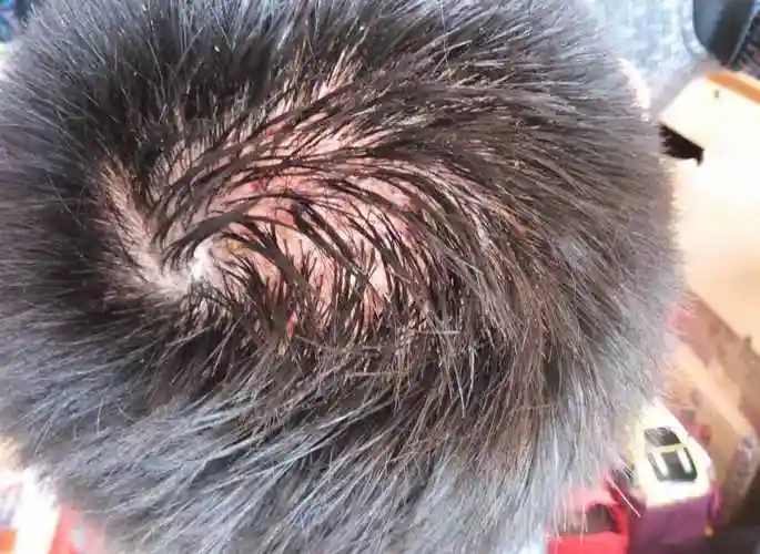 头发毛囊堵塞怎么办头发毛囊闭合图片