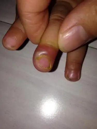 我家宝宝十个月,手指怎么回事?现在不敢动,还红肿!怎么办?