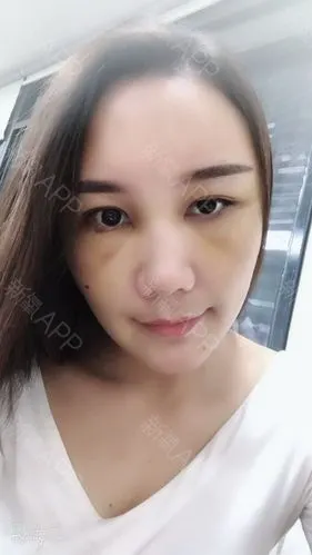 苹果肌.泪沟几个部位_圈子-新氧美容整形