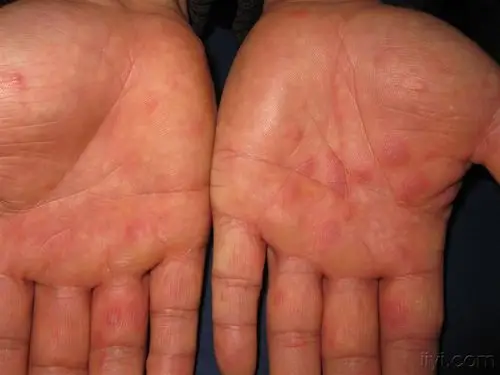 我们回家了多形红斑性药疹