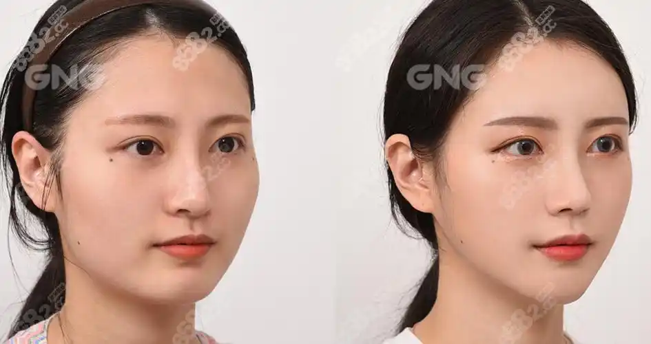 韩国gng整形医院颧骨磨骨术前后对比图