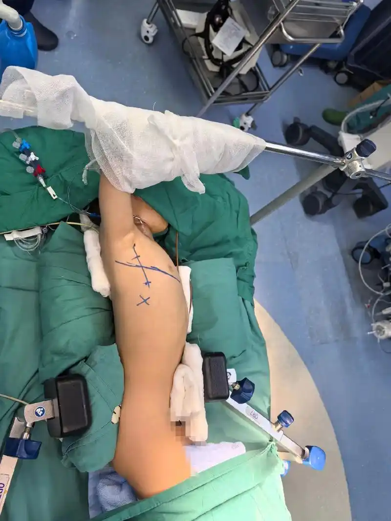 右腋下美容小切口,非股动,静脉插管,体外循环心内直视vsd修 - 抖音