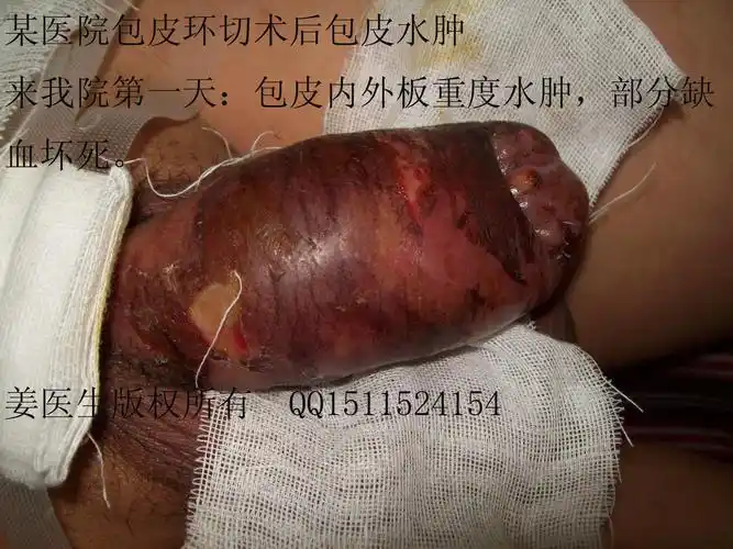 惨痛的教训(二):在某小医院做了"包皮环切术"后出现包皮重度坏死 - 好