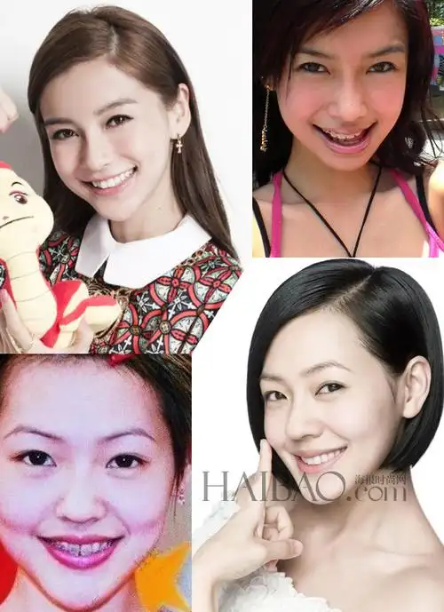 一起来盘点那些整过牙就变仙女,王子的明星们.