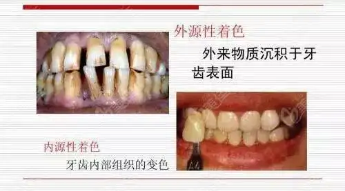 美白牙贴真的可以美白牙齿吗看看它的副作用再说吧