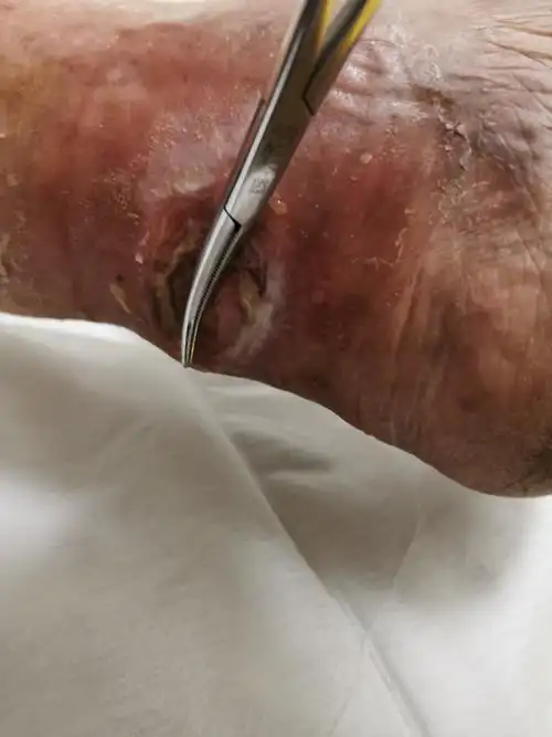 一例慢性溃疡病例 - 美篇