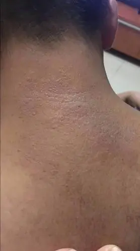 我有个朋友,夏天一嗮太阳,脖子后面就会长这些皮痒,他说好痒.