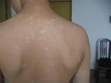 部位,这些部位包括有面部,颈部,四肢等部位,如果这些部位最先出现白斑