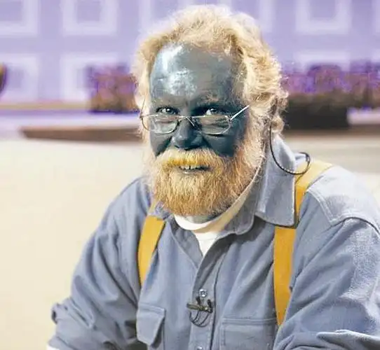 美国男子服药皮肤变蓝色 如阿凡达"纳美人"(图)