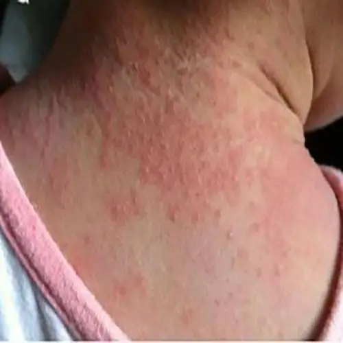 丘疹湿疹症状图片_有来医生