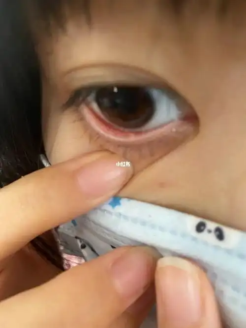 求助!两个下眼睑都长了一个白色的条条_医疗健康_医疗健康其他