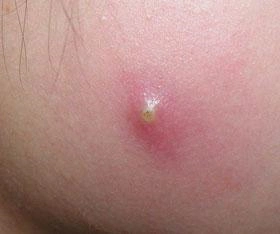 1.疖疖俗称疔疮,是指单个毛囊及其所属皮脂腺的急性化脓性感染.