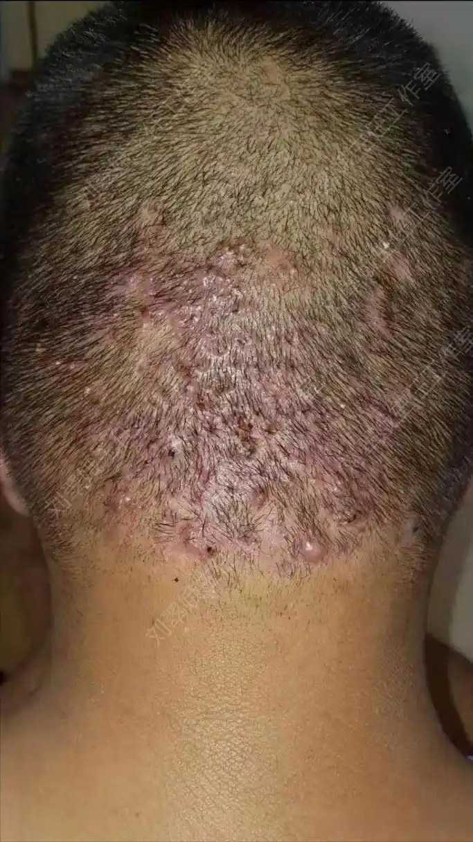 头上疙瘩此起彼伏 慢性毛囊炎3年 中医调理有办法  有一个23岁的