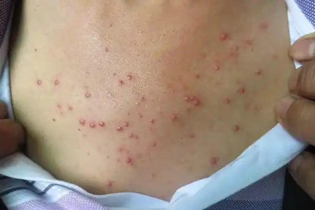 性毛囊炎最常见的病因,早期临床表现为凸起的红色毛囊性丘疹或脓疱,常