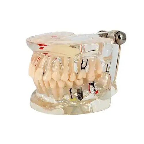 成人病理种植牙齿模型口腔模型牙科教学模型演示模型牙模型