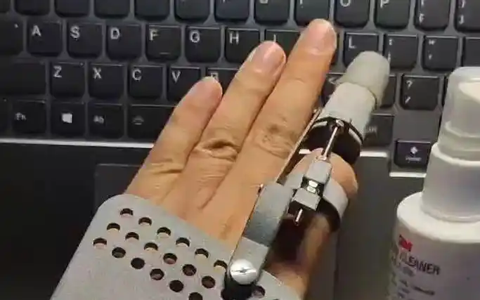 通用型的手指假肢