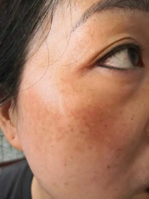 解决皮肤问题专注皮肤美容##使用化妆品过敏的这么多是为什么?