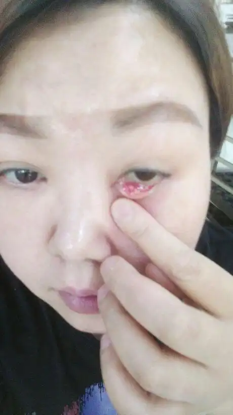 我眼睛里面长了个白色的东西怎么治