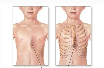 鸡胸问答_鸡胸患者咨询-有来医生